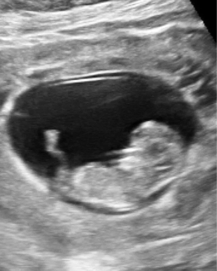 Follow-up Early OB Exam