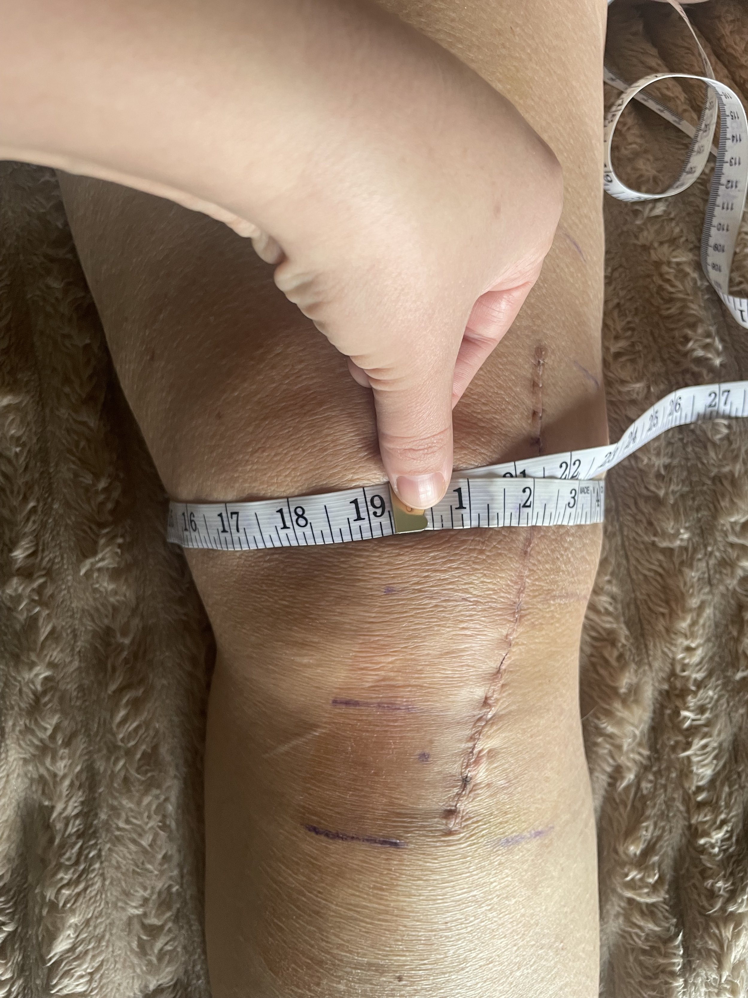 Before Above Knee