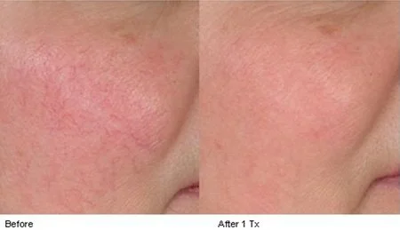 Veins before n after.jpg