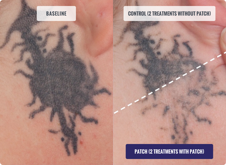 How Long Does Laser Tattoo Removal Take  Vanish Laser Clinic Alexandria VA