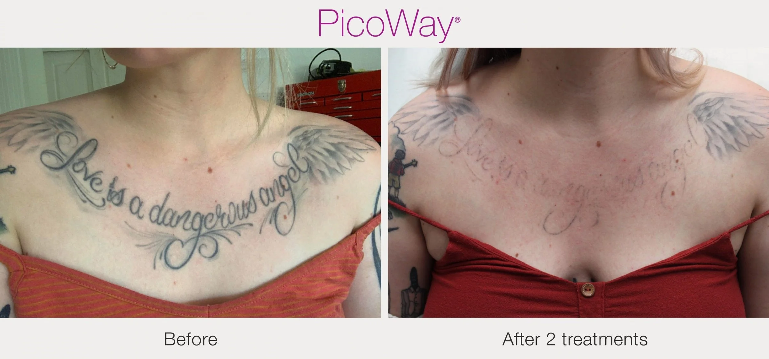 PicoWayBeforeAndAfter7.jpg
