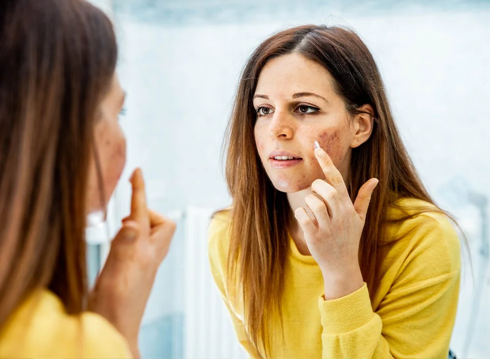 acne-cream-fda.jpg