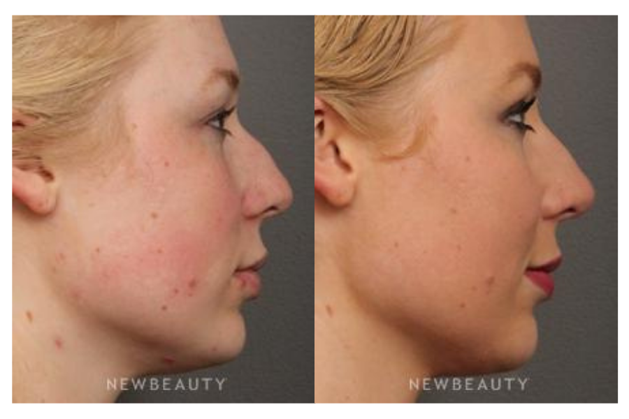Female, 25 – 34
Treatments: Botox, Botox Browlift, Chemical Peel, Juvederm, Juvederm Volbella, Juvederm Voluma