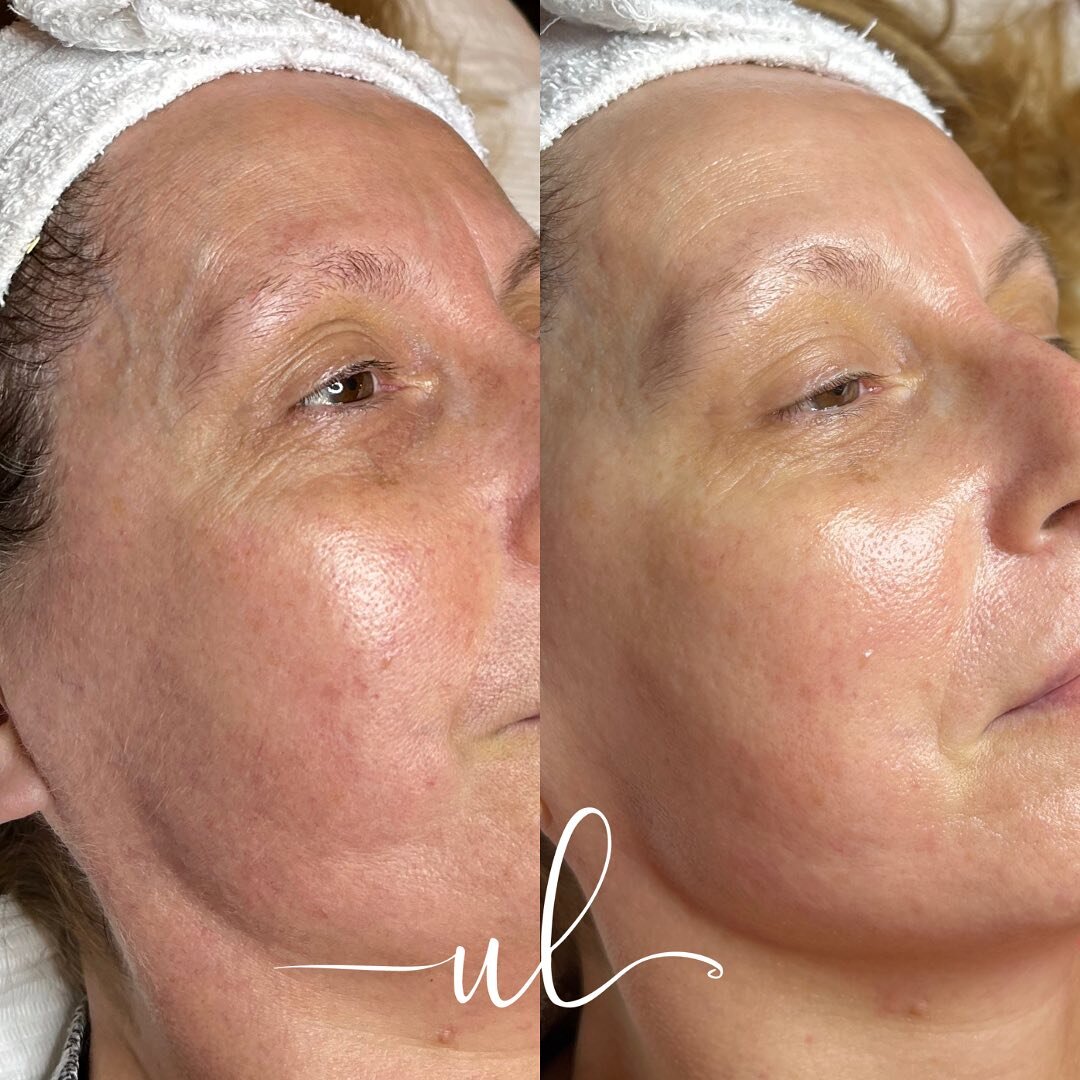 We love a post Dermaplaning GLOW ✨ 

Dermaplaning doesn't just remove vellus hair (peach fuzz 🍑), there are many amazing benefits! 

- advanced exfoliation

- better product absorption

- lessens the appearance of fine lines &amp; wrinkles, acne sca