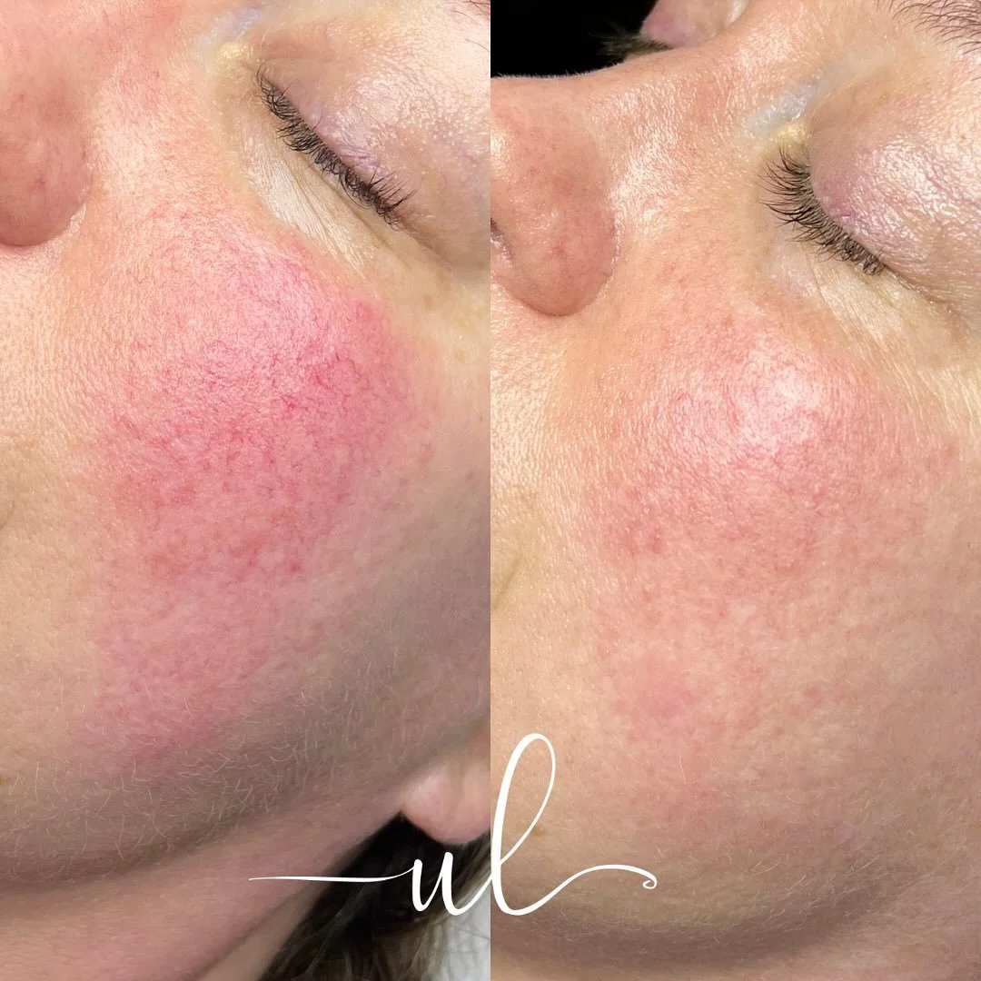 The power of IPL ⚡️

IPL (intense pulsed light) is a powerful skin treatment that breaks down pigment in the skin, stimulates collagen production, and more.

Pictured is a Before &amp; After from only one treatment, targeting veins/capillaries and re