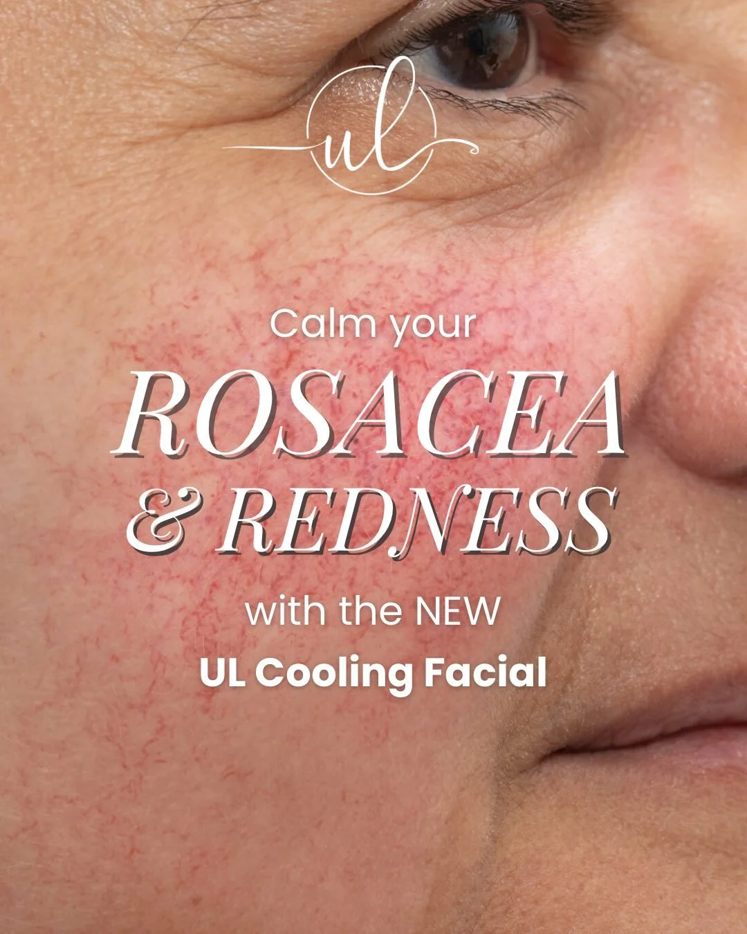 If you have rosacea, you know rosy cheeks aren&rsquo;t all they&rsquo;re cracked up to be.

🧊 Introducing our newest service, the specialized UL Cooling Facial! 🧊

Designed specifically for people that struggle with redness and rosacea, this rejuve