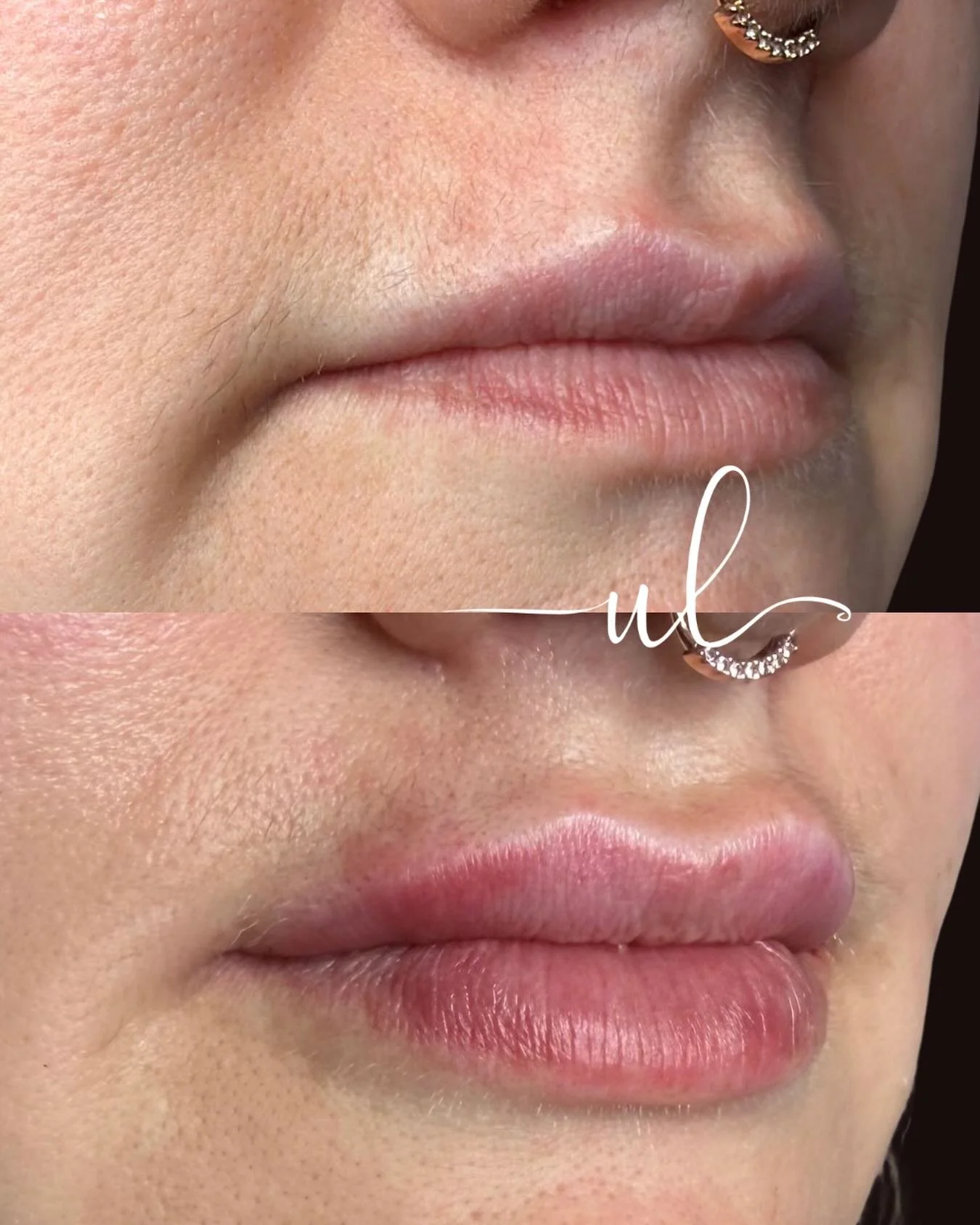 plump, defined + balanced lips 💋 

beautiful transformation by Becky, RN using HA filler 😍

✨ our injections appointments are booking up fast for June with only limited appointments left! Call or DM us to book!