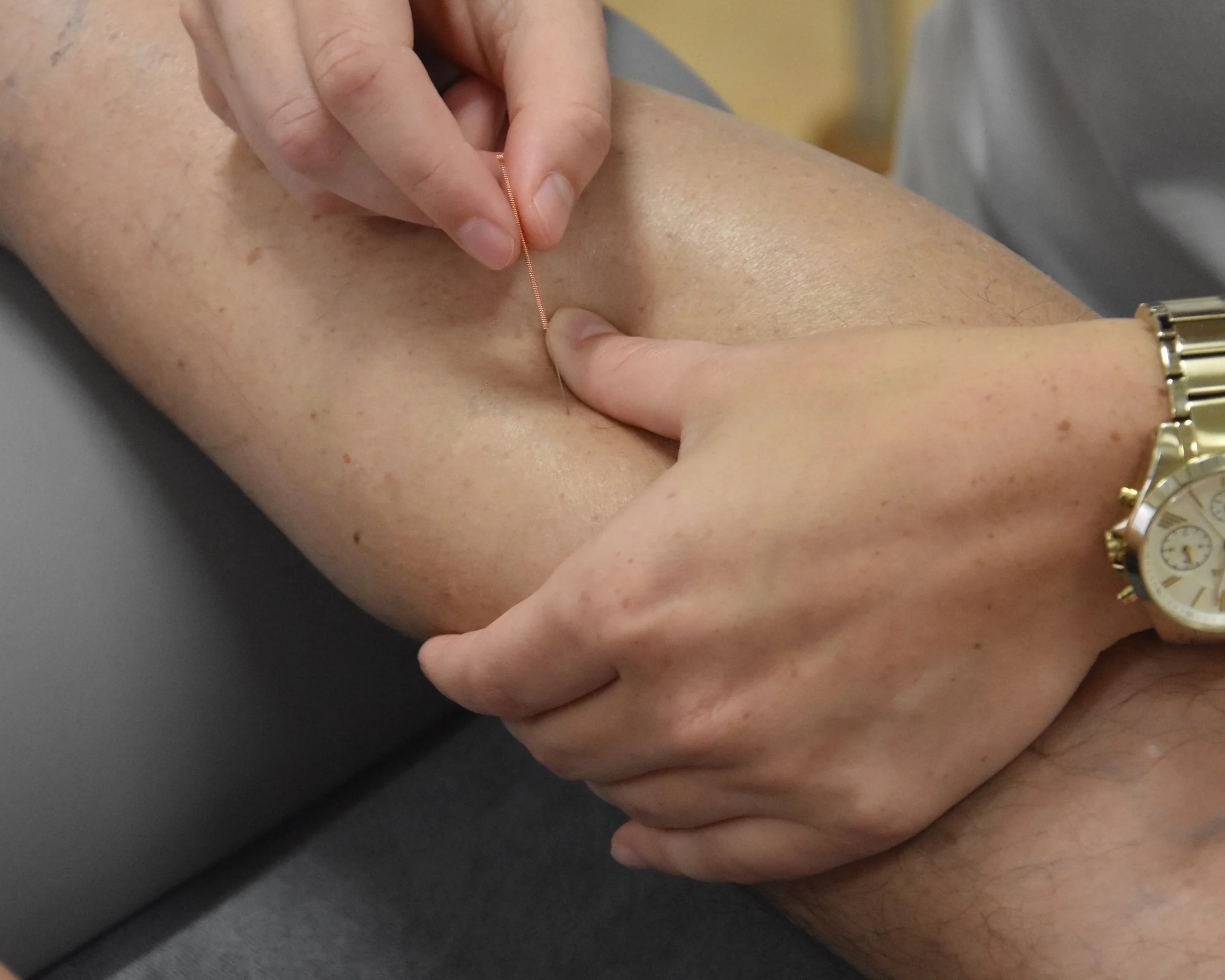 Acupunctuurbehandeling op een arm met een hand die een naald vasthoudt.