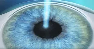 Pourquoi opter pour la chirurgie réfractive ?