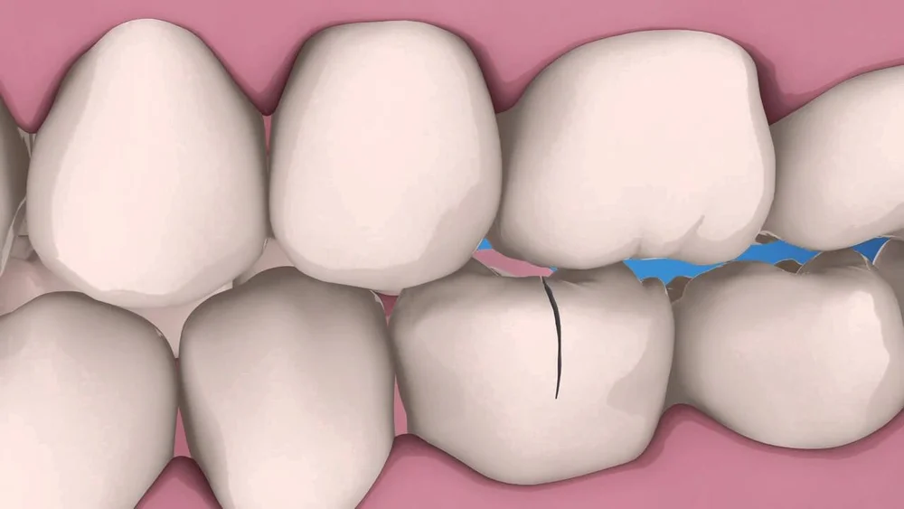 Traumatic Injuries — Endodontic Care (Copy) (Copy)
