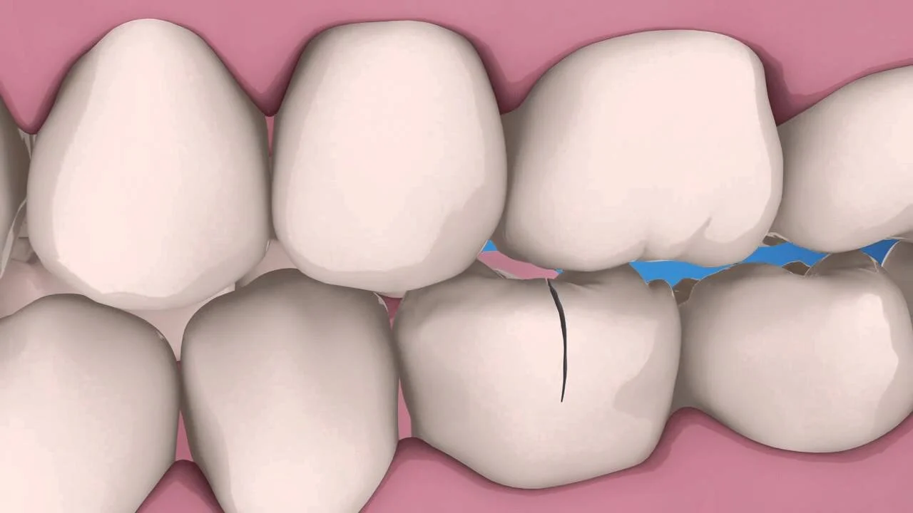 Traumatic Injuries — Endodontic Care (Copy) (Copy)