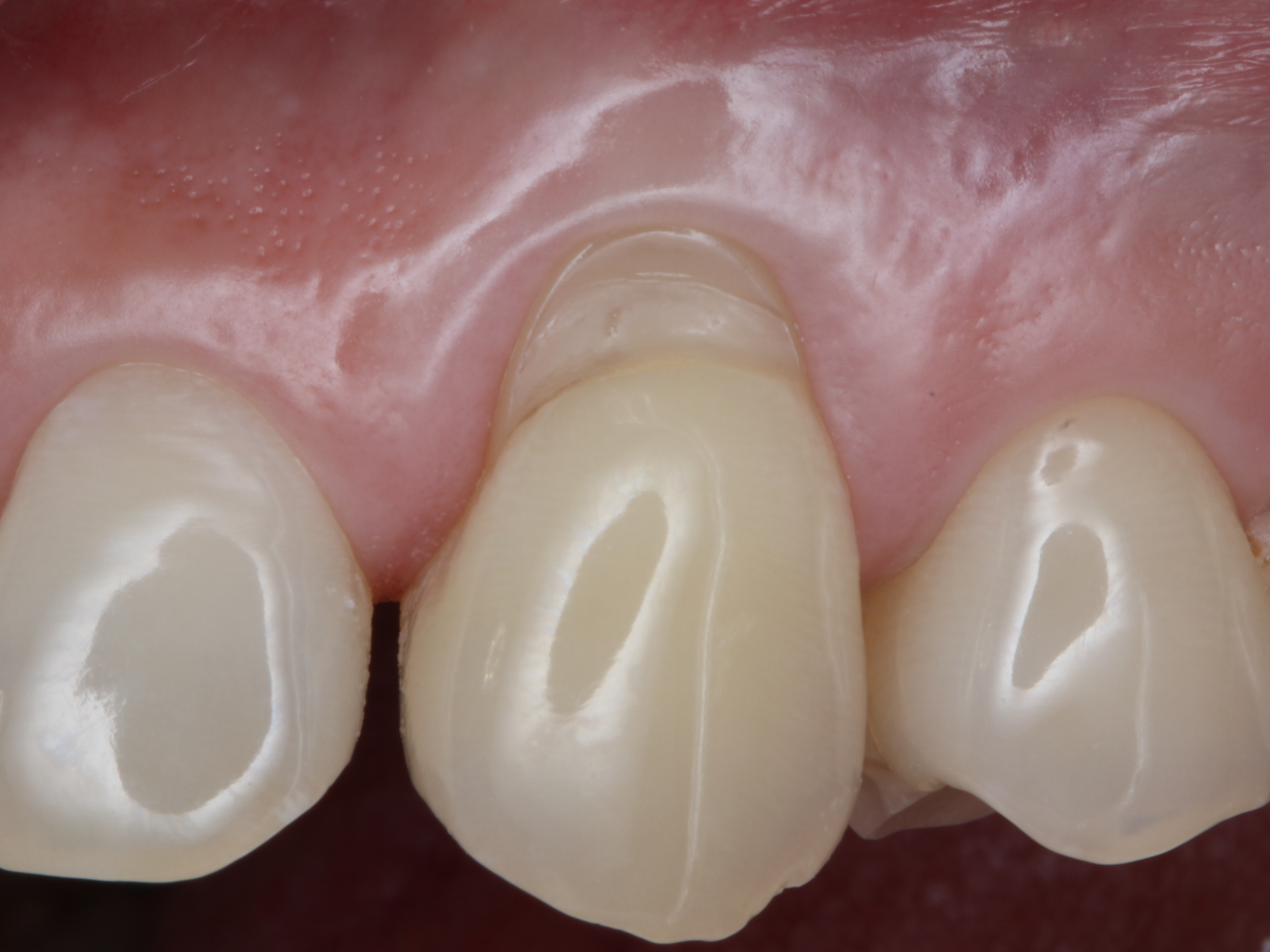 Pleasant Dental Brookline Soft Tissue Before