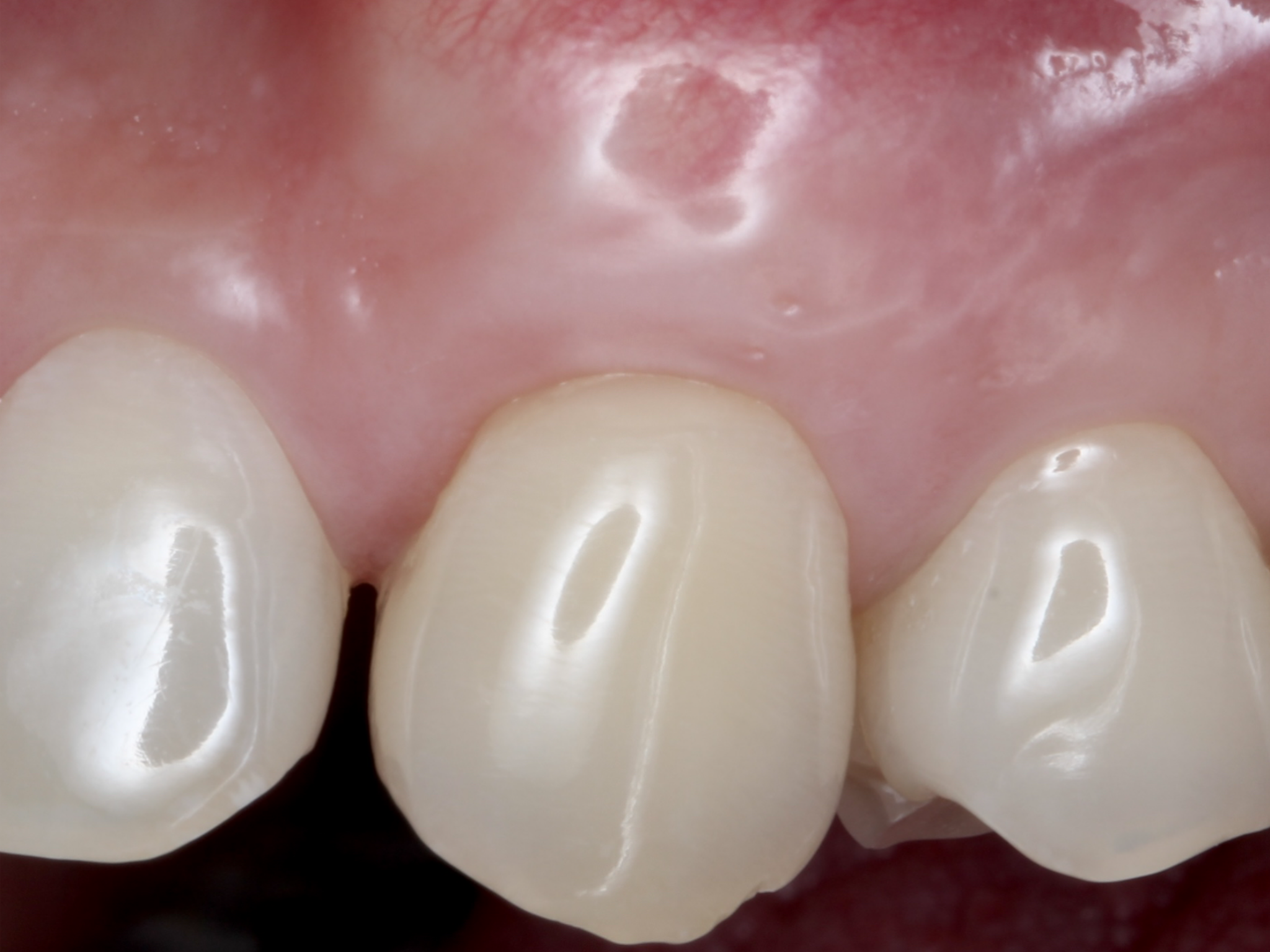 Pleasant Dental Brookline Soft Tissue After