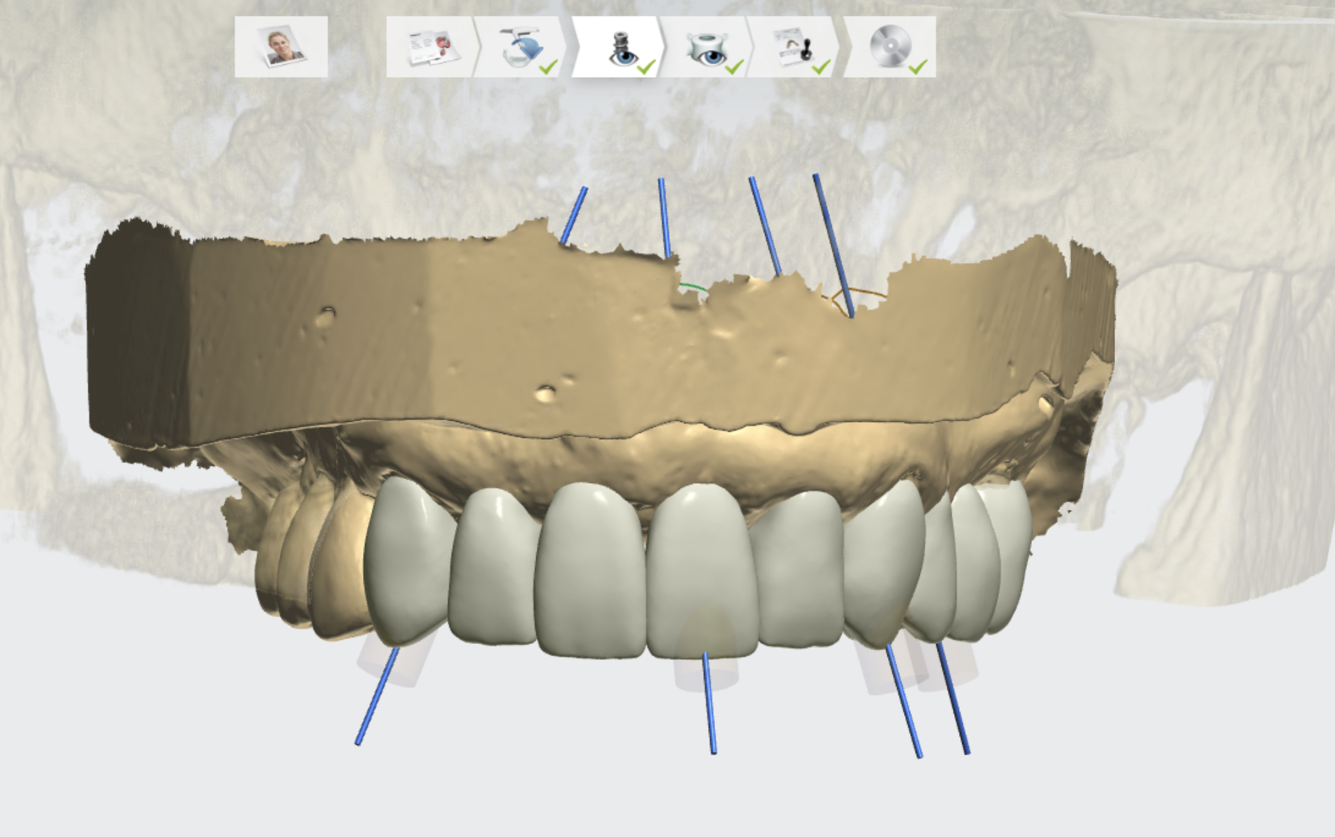 Pleasant Dental Brookline Implant Planning