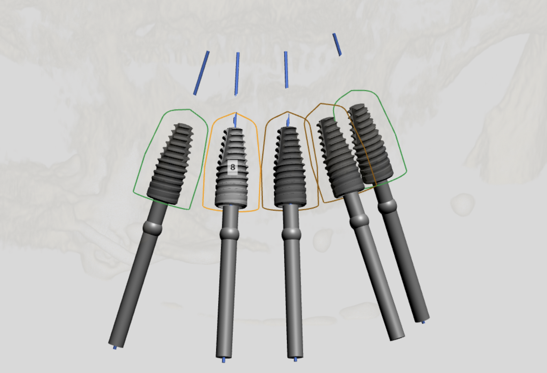 Pleasant Dental Brookline Implant Digital Planning