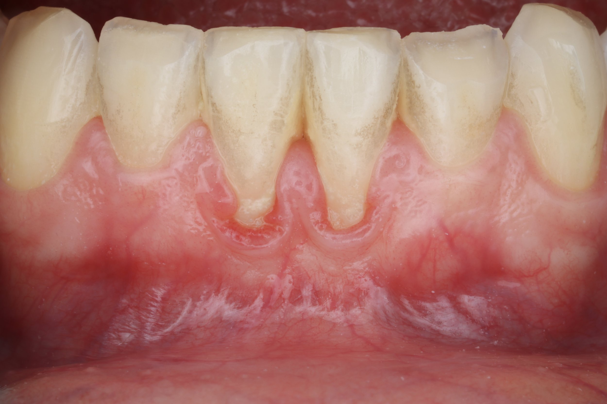 Gum Recession Treatment in Brookline: What Causes It and How We Fix It
