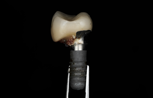 Peri-Implantitis: The Infection That Can Destroy Your Dental Implant