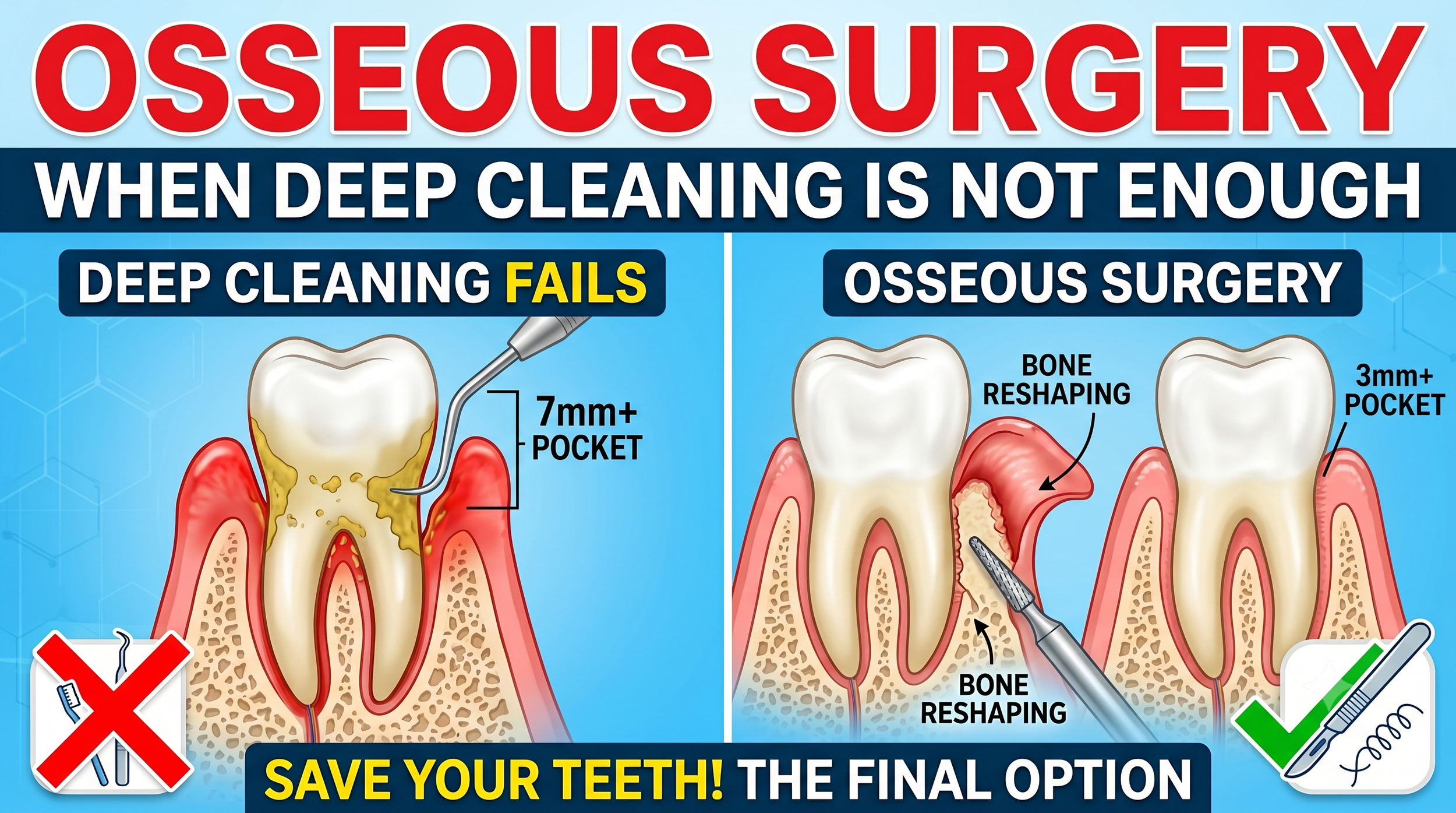 Osseous Surgery: When Deep Cleaning Is Not Enough 骨修整手術：當深層清潔還不夠時