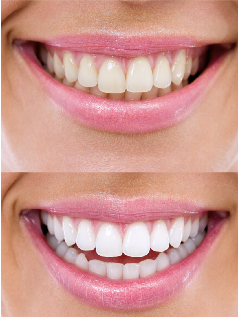 DENTISTRY-ON-STEELES-TEETH-WHITENING-BEST-LOCAL-DENTIST-NEAR-CLINIC-VAUGHAN-WOODBRIDGE-TORONTO-ETOBICOKE-YORK-AFFORDABLE-IMPLANTS-VENEERS-ISLINGTON-FAMILY-COSMETIC.png