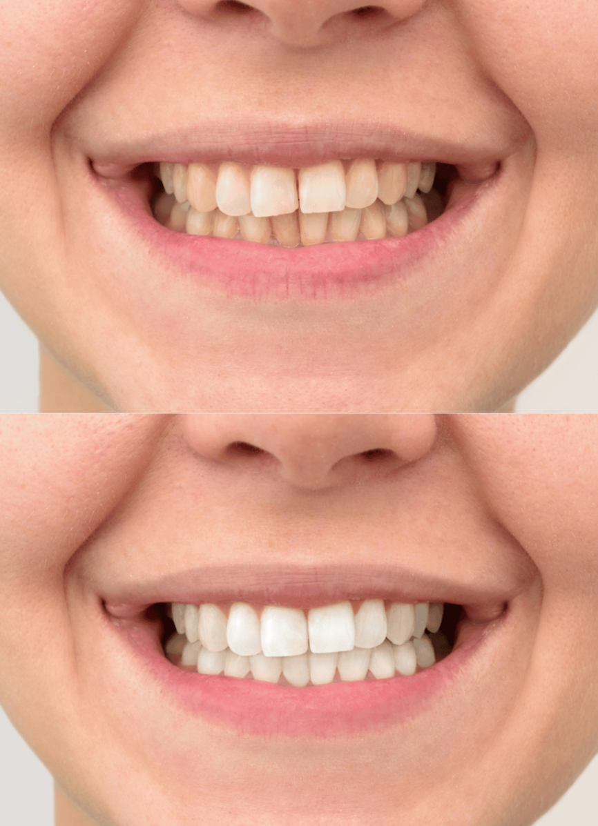 DENTISTRY-ON-STEELES-TEETH-WHITENING-BEST-LOCAL-DENTIST-NEAR-CLINIC-VAUGHAN-WOODBRIDGE-TORONTO-ETOBICOKE-YORK-AFFORDABLE-IMPLANTS-VENEERS.png