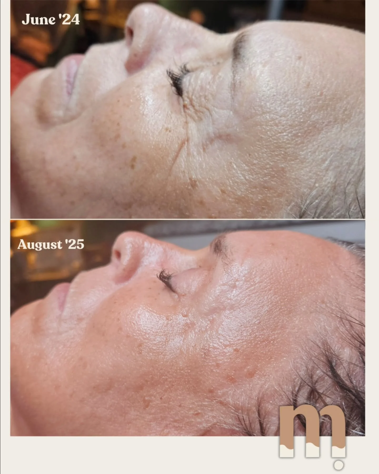 We're Aging in reverse ◀️ 

#antiaging #antiagingomaha #oxygentherapyomaha #omahafacialtreatment
#omahamicrochanneling #omahamicroneedling