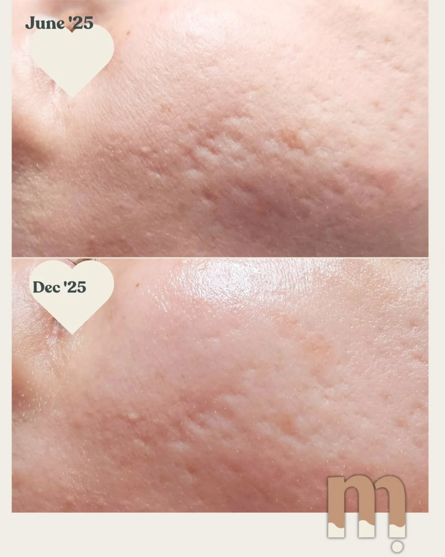 The results after her 6 month treatment plan of microchanneling sessions and glycolic peels. 🥹🤍

We both can't wait for her results to just keep getting better with time and consistency. 

You CAN reduce scarring and rebuild collagen. You just need