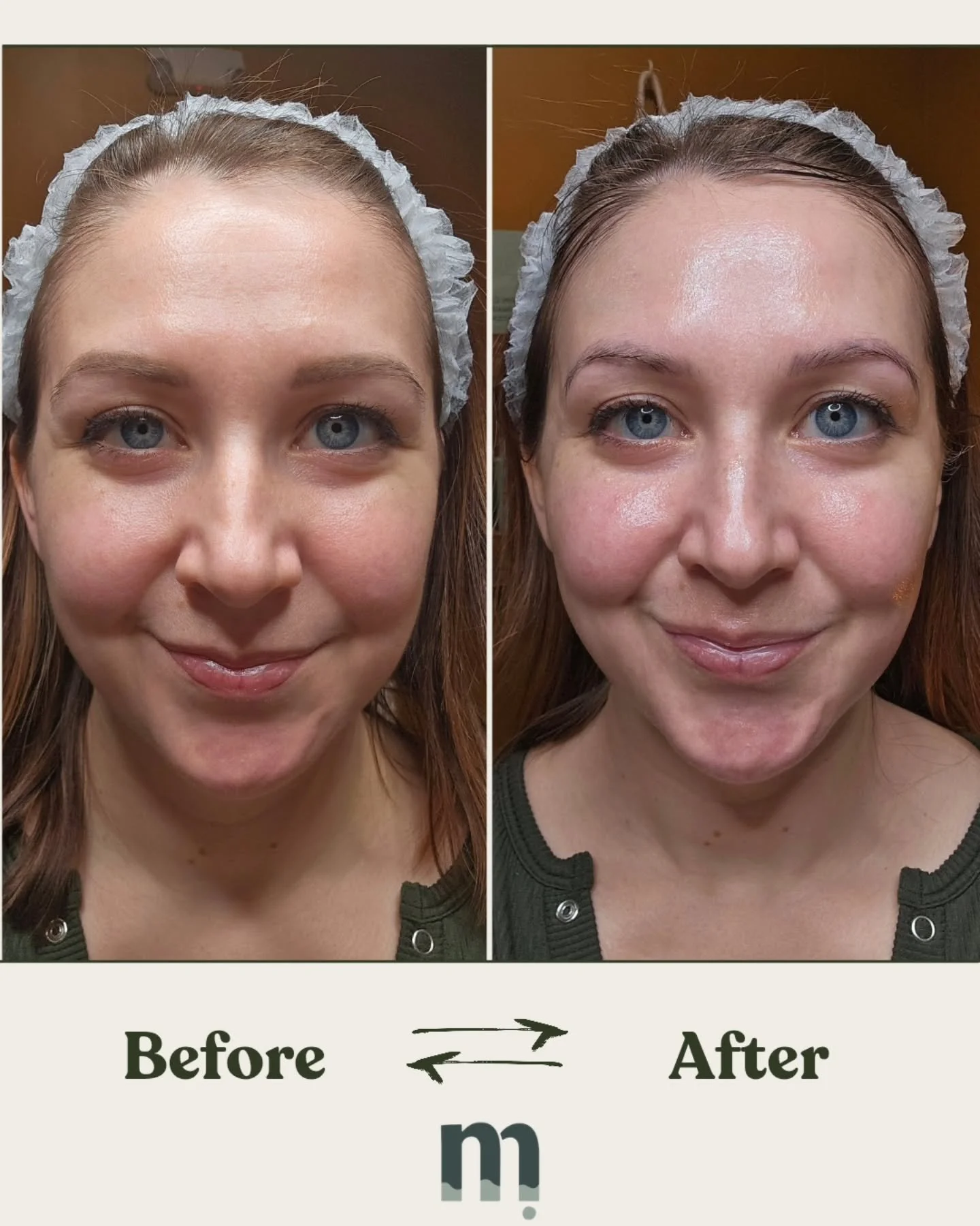 🙋&zwj;♀️ its me!!!

Check my stories for a close up. But my results after this treatment needed to be documented. Feeling so soft and glowing. My skin definitely needed a pick me up. 🤍