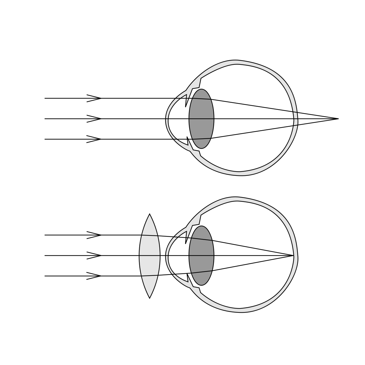 Hypermétropie : l’image se forme derrière la rétine ; un verre positif permet de la ramener sur la rétine.