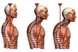 Your Rounded Shoulders Are Not a Posture Problem. They Are a Strength Problem.
