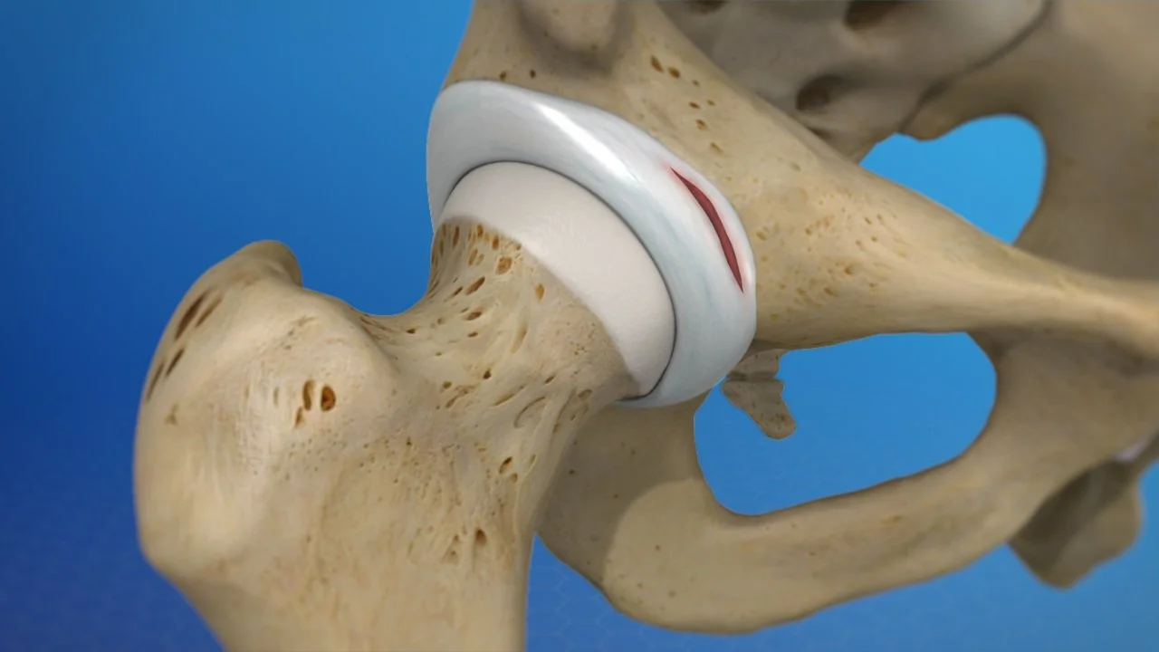 Labral Tear Hip.jpg