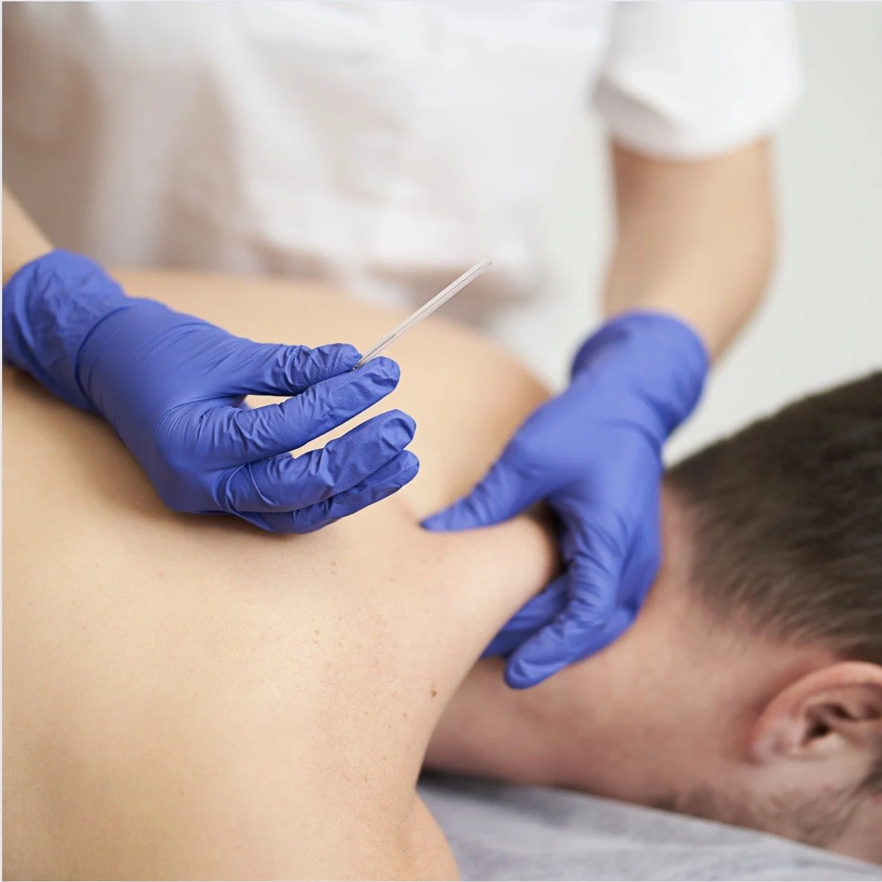 thin filament sterilized trigger point dry needling