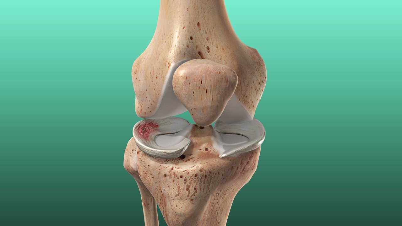 Meniscus tear.jpg