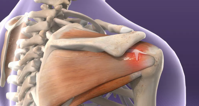 Rotator Cuff Tear Final.PNG