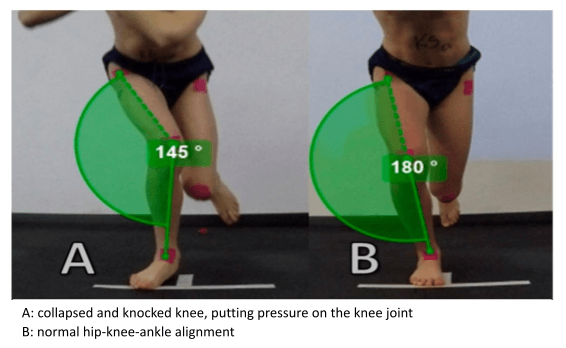 Understanding Hoffa’s Fat Pad Syndrome - Elite Health & Performance