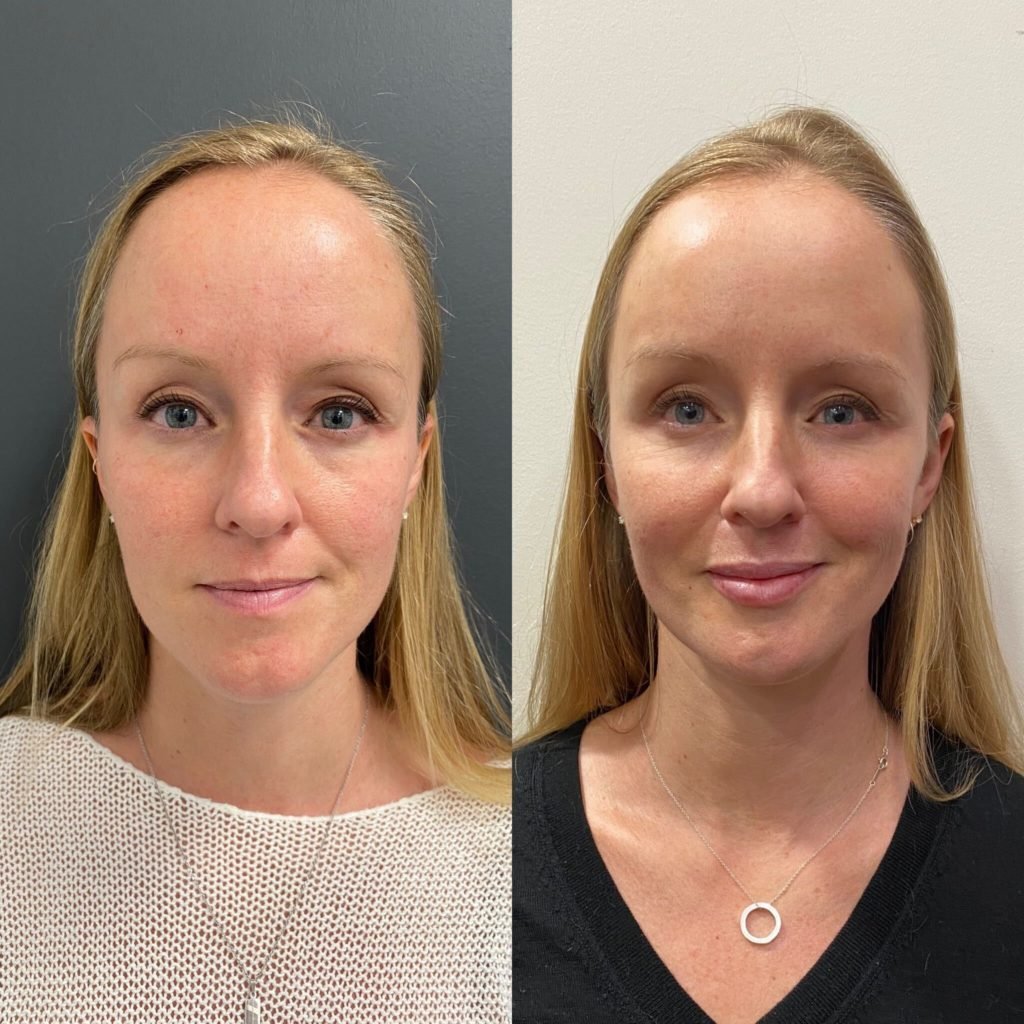 before-after-facial-filler-1024x1024.jpg