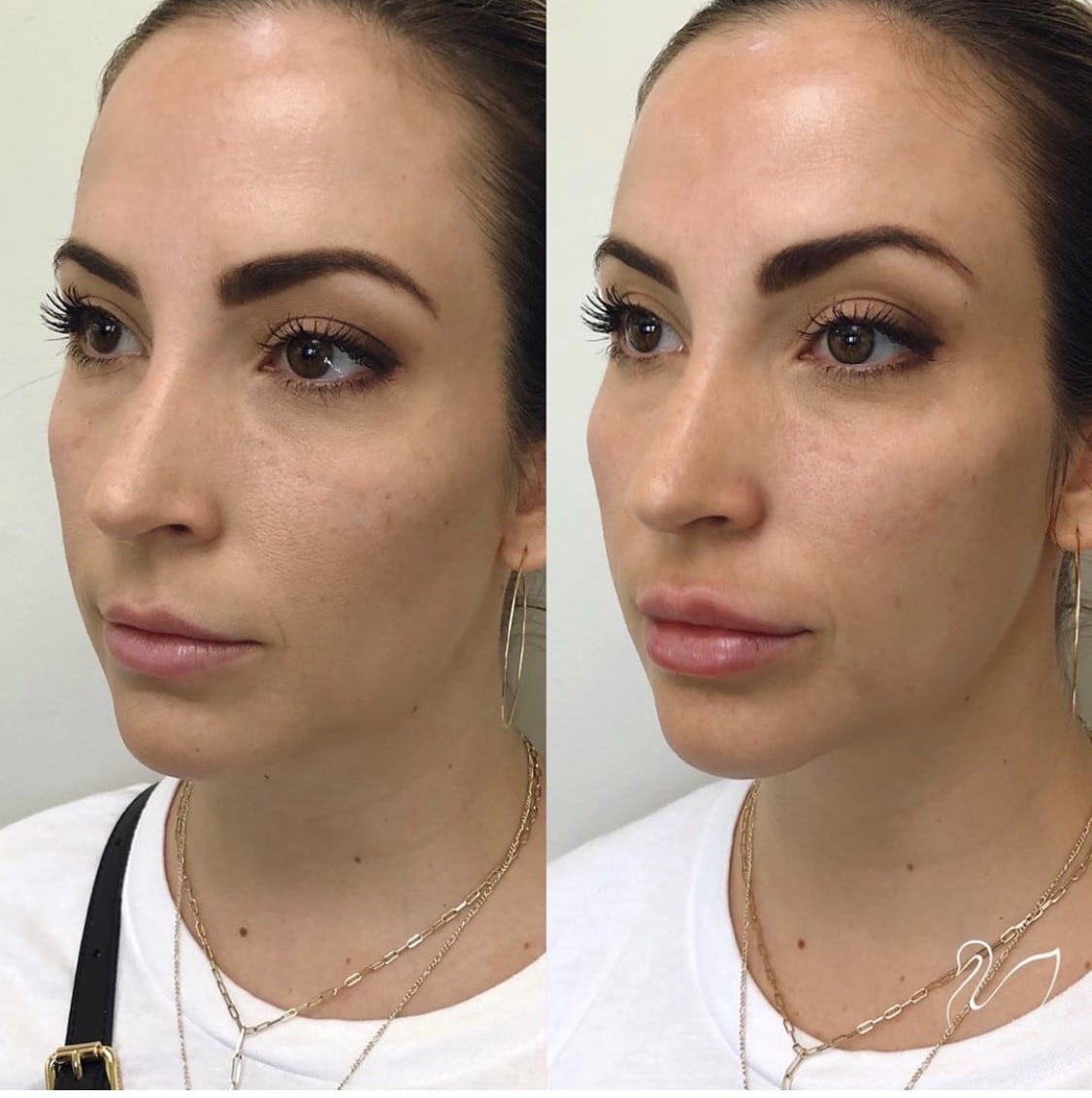 1-syringe-Juvederm-Voluma-Cheek.jpg