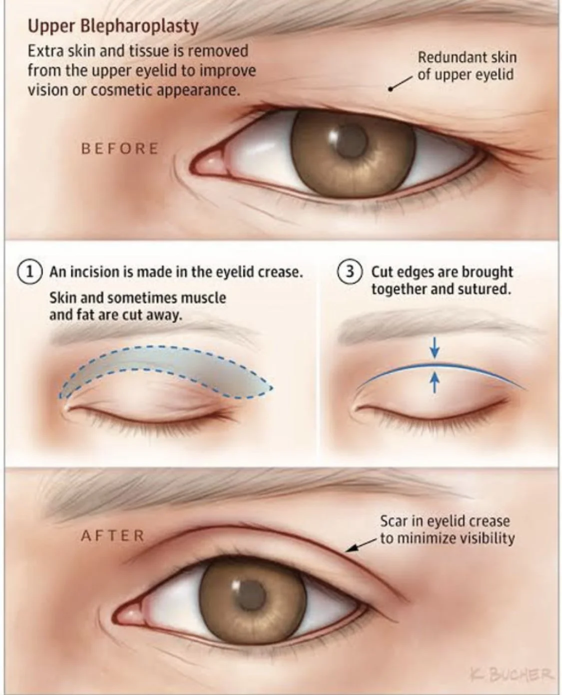BLEPHAROPLASTY Are droopy eyelids making you feel old? — QUAY