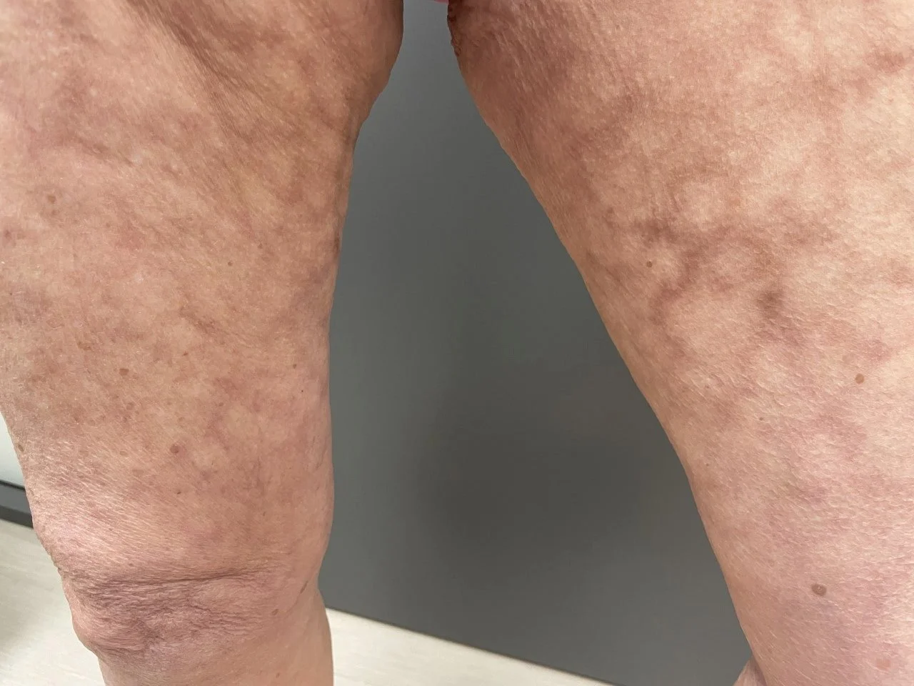 Erythema ab igne (EAI) Case Study