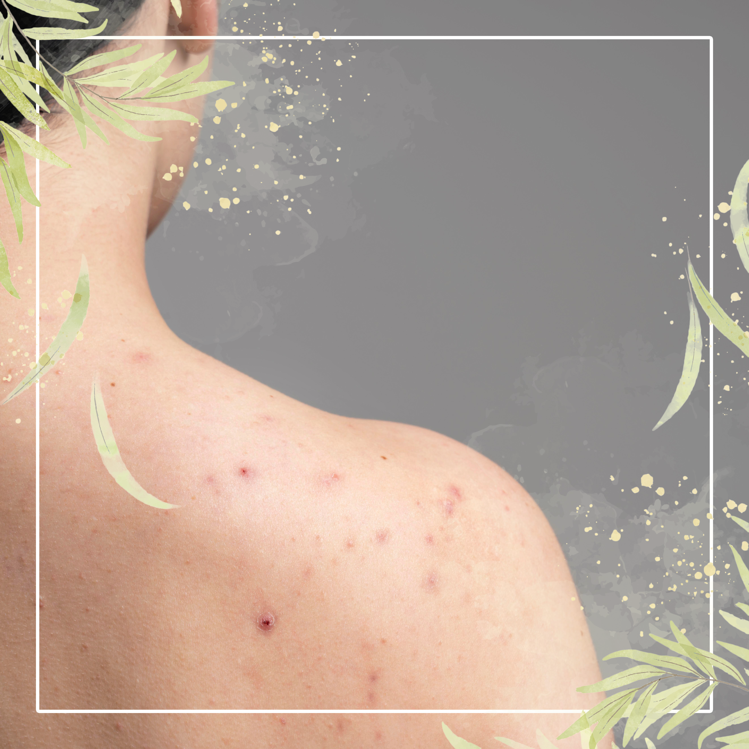 INSTAN! CARA MENGATASI JERAWAT PUNGGUNG