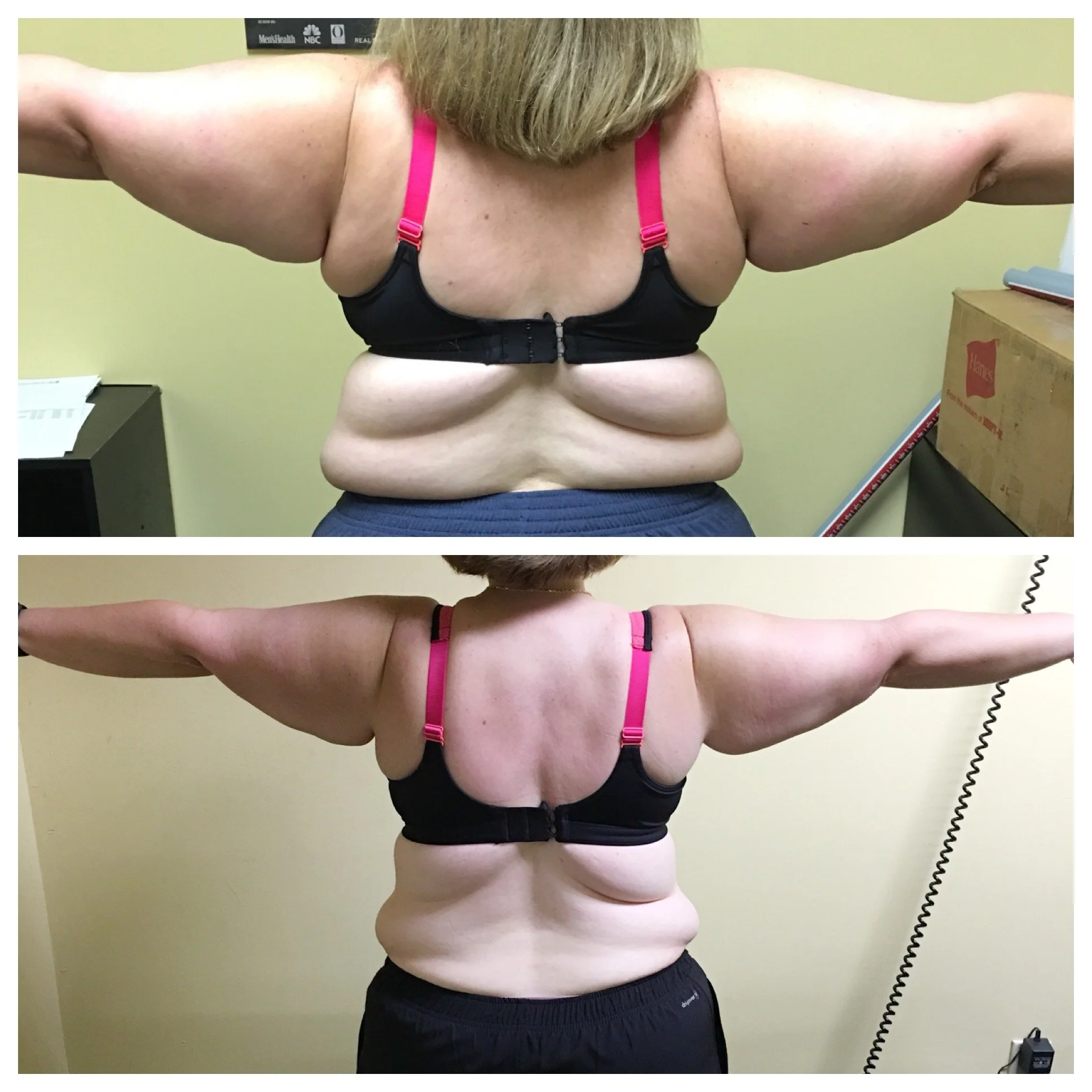 female-back-progress-dr-phillips-personal-training.jpg.JPG