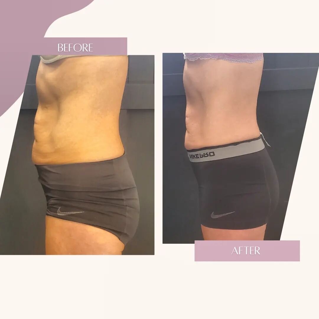 This client is down an inch and a half in just 3 treatments of #bodycontouring 
Summer is just getting started.  Book your consultation today!!!