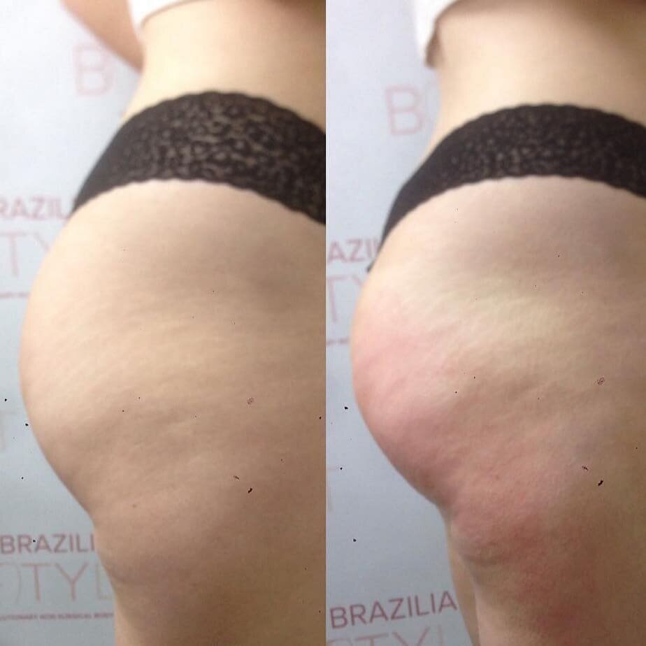 Booty gains 🍑🤩🔥
-
This machine is unstoppable 🔥
-
Book in bio or DM us to book your course ✨
.
.
.
#bums #tummytuck #nonsurgicaltummytuck #treatyourself #beforeandafter #metime #getridofcellulite #slimdown #weightloss #beautynottinghamshire #beau