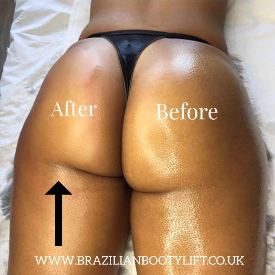 Seeing that lift as you do the treatment!!! 😱❤
DM us or book in bio
.
.
.
#bumlift #bum #snatched #booty #hourglass #flattummy #biggerbum #nonsurgical #brazilianbootylift