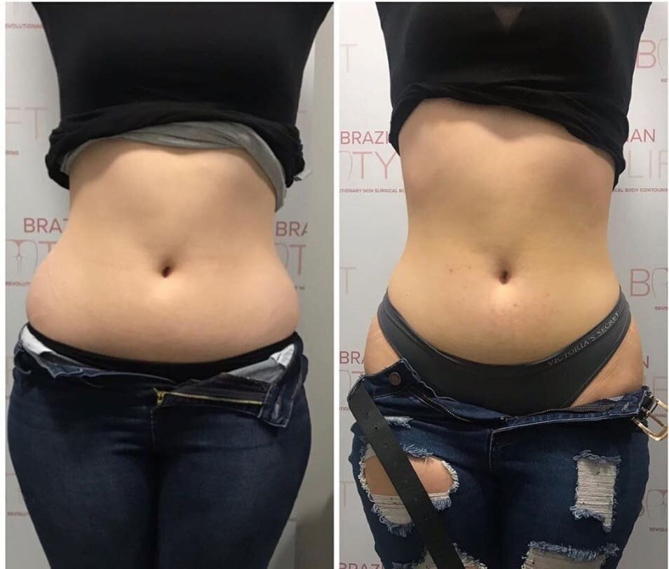 Snatched 🙌😘 
Book your course.. DM us or book in bio ❤ 
.
.
.
#brazilianbootylift #bum #booty #bootylift #snatched #backfatbegone #bingowingsbegone #beforeandafter #nodietshere #nogymneeded