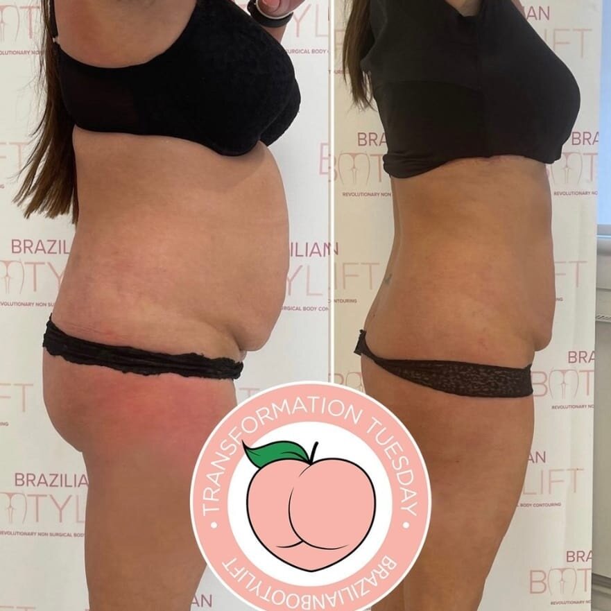 Transformation Tuesday😱💫⁠
⁠
An AMAZING result in only 3 WEEKS
⁠
Get your curves sculpted before the Xmas celebrations⭐️⁠
⁠
Link in our bio🙌🏻
.
.
.
#beauty #makeover #beforeandafter #beforeandafterweightloss #beautynottingham #beautyderby #bumlift