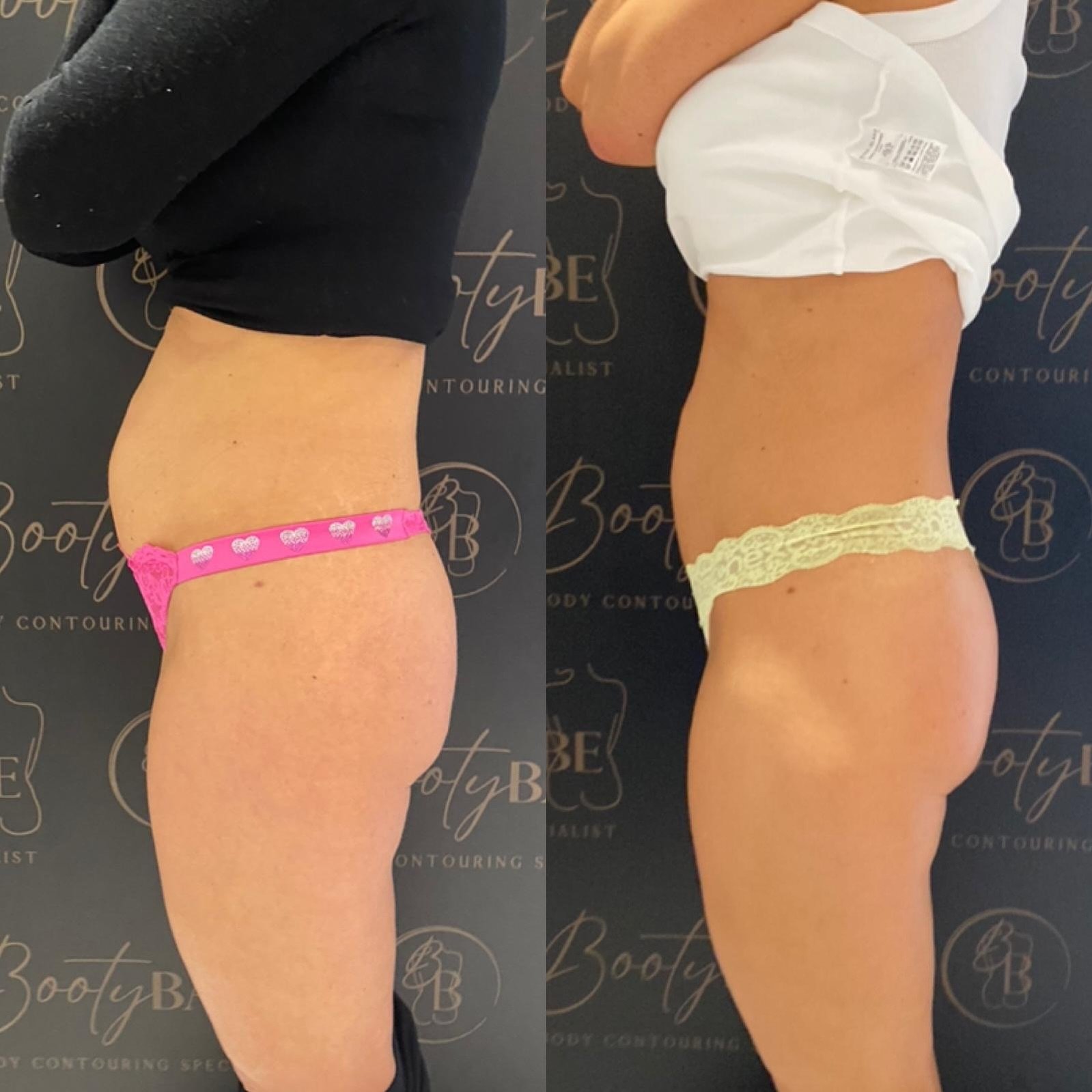 Incredible results so far for another beautiful client 🥰🥰

✅ DM to book your appointments
✅ DM about our machine &amp; training 

#tummytuck #nonsurgical #nonsurgicaltummytuck #inchloss #skintightening #collagen #cavitation #radiofrequency #ripley 
