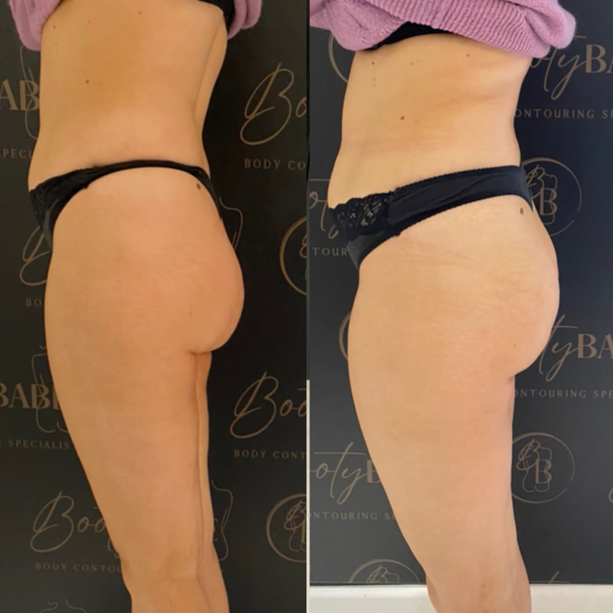 First session bbl results! Fuller, rounder and lifted bum in 1 hour! A course of 5 is recommended for best results and long lasting results ❤️ DM us to book your bbl for summer! 

✅ DM to book your appointments
✅ DM about our machine &amp; training 
