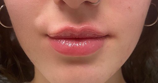 This is your sign to get the lips! 👄 This beauty wanted to enhance her upper lip so that&rsquo;s what we did! 🪄