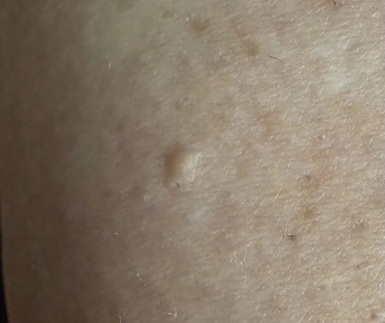 Minor skin imperfection removal. Takes about 5 minutes.