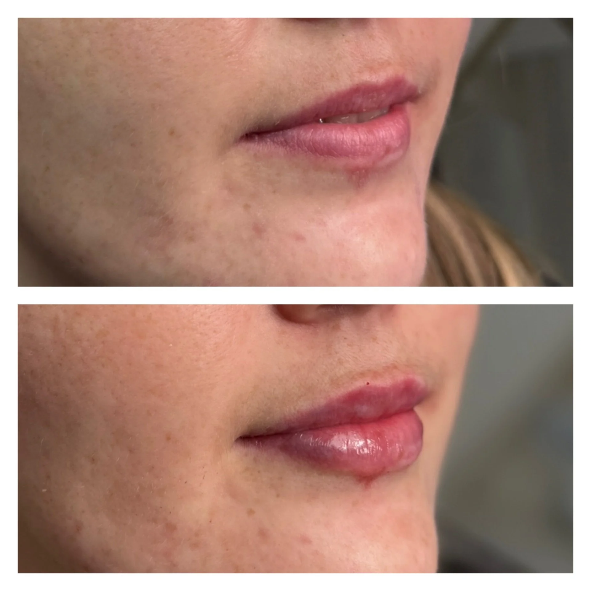 lip filler.JPG